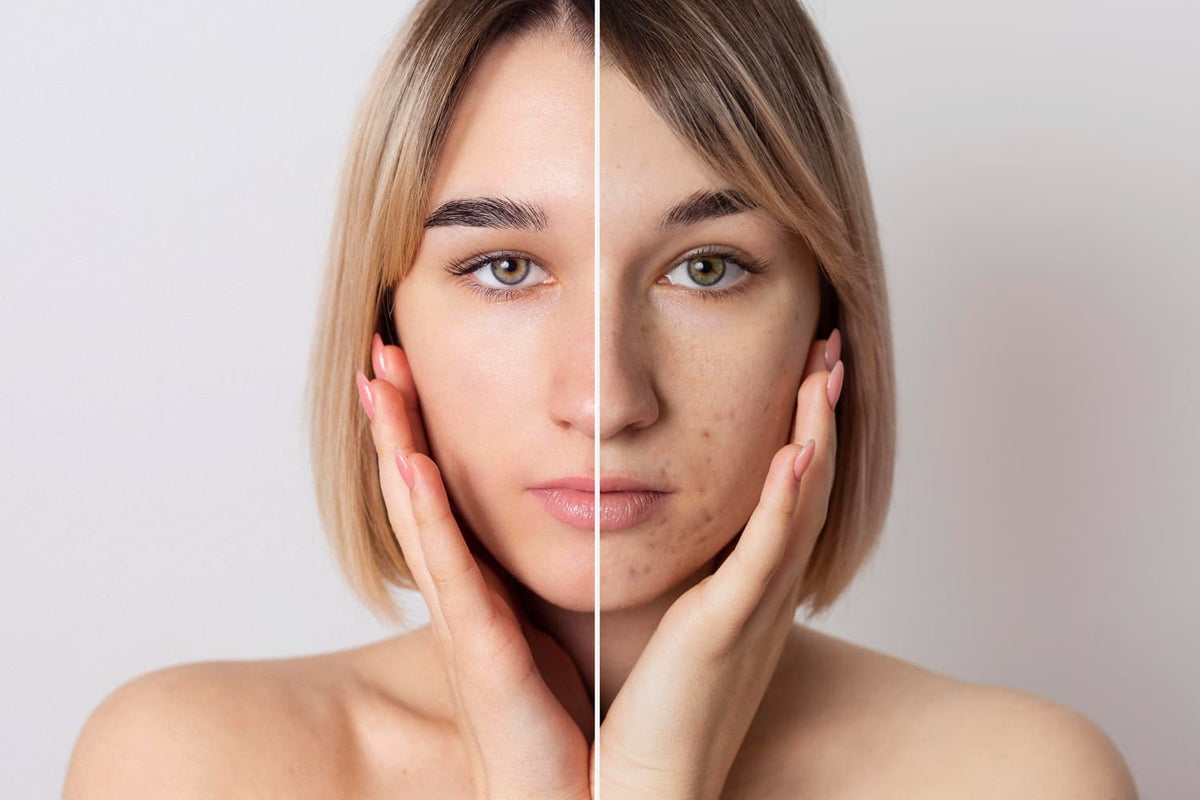 Spots Left Over from Summer: Fall Dark Spot Treatment and Makeup Camouflage — Alix Avien blog image