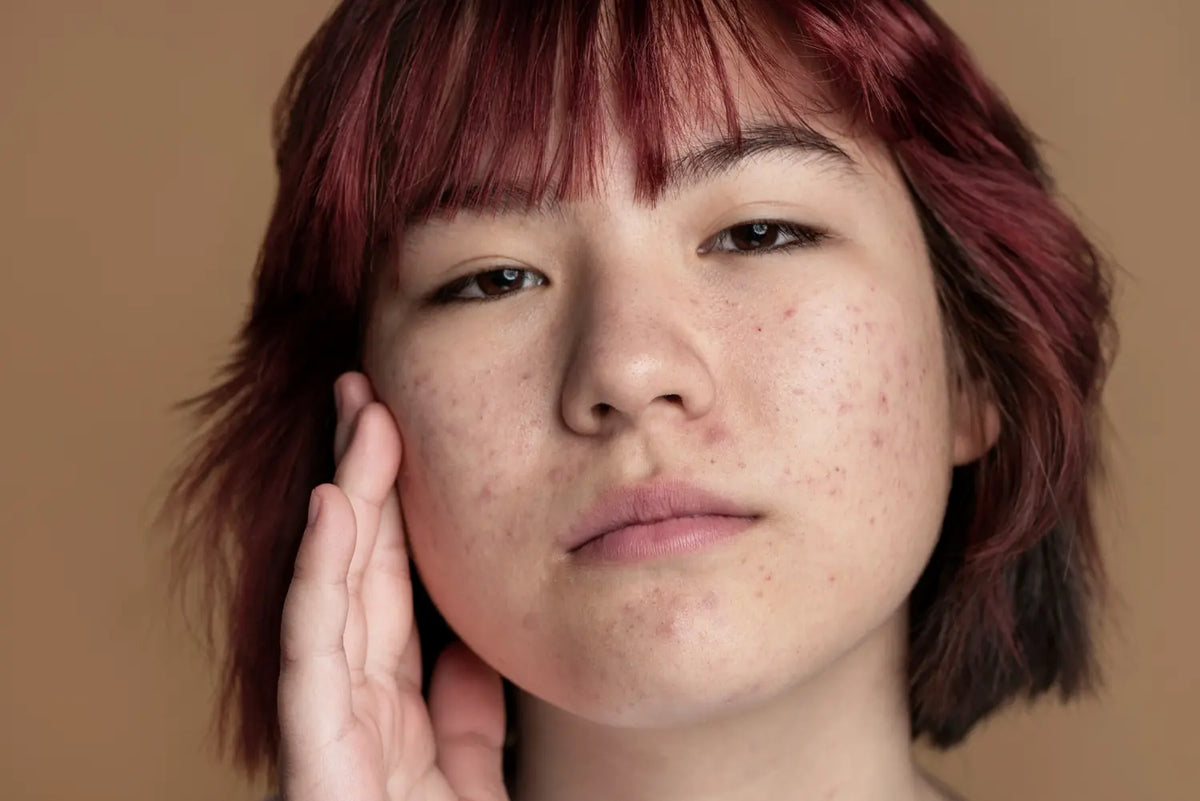 Until What Age Does Teenage Acne Last? Concealing Breakouts with Makeup — Alix Avien blog image